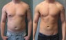Gynecomastia