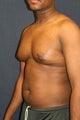 Gynecomastia