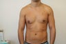 Gynecomastia - Male Breast Reduction