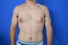 Gynecomastia - Male Breast Reduction
