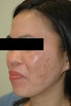 Melasma Treatment Before and After Photos