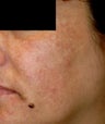 Melasma Treatment