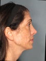 Premier Perfecting Peel
