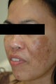 Melasma Treatment Before and After Photos
