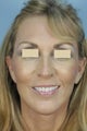 Qt Mini-Facelift with chin augmentation