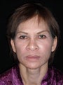 Vertical face lift, four lid blepharoplasty, transblepharoplasty brow lift