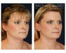 Full Facial Rejuvenation