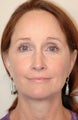 Mini face lift with endoscopic brow lift