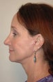 Mini Face Lift