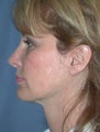 Mini-Facelift, Brow lift, Upper Eyelid Surgery