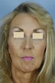 Qt Mini-Facelift with chin augmentation