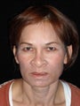 Vertical face lift, four lid blepharoplasty, transblepharoplasty brow lift