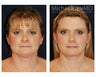 Full Facial Rejuvenation