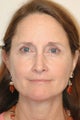 Mini face lift with endoscopic brow lift
