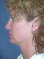 Mini-Facelift, Brow lift, Upper Eyelid Surgery