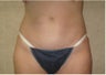 Abdominoplasty