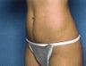 Mini Tummy Tuck