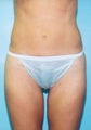 Mini-Tummy Tuck with Liposuction