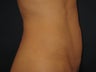 Mini tummy tuck