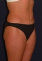 Tummy Tuck / Abdominoplasty