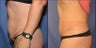 Mini Tummy Tuck