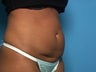 Mini Tummy Tuck