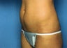 Mini Tummy Tuck