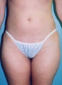 Mini-Tummy Tuck with Liposuction