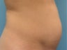 Mini tummy tuck