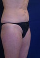 Tummy Tuck / Abdominoplasty