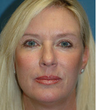 Mini Lift, Eyelid and Brow Lift Surgery
