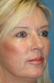 Mini Lift, Eyelid and Brow Lift Surgery