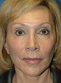 Mini Lift and Injectable Fillers