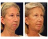 Facial Rejuvenation
