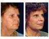 Facial Rejuvenation
