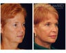 Facial Rejuvenation