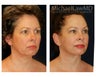 Facial Rejuvenation