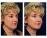 Facial Rejuvenation