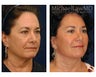 Facial Rejuvenation