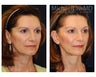 Facial Rejuvenation