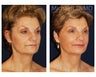 Facial Rejuvenation
