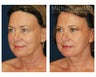 Facial Rejuvenation