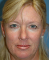 Mini Lift, Eyelid and Brow Lift Surgery