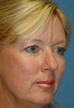 Mini Lift, Eyelid and Brow Lift Surgery
