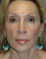Mini Lift and Injectable Fillers