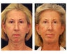 Facial Rejuvenation