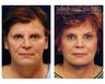 Facial Rejuvenation