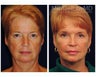 Facial Rejuvenation