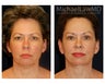 Facial Rejuvenation