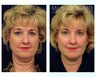 Facial Rejuvenation